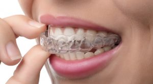 Invisalign