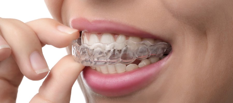 Invisalign in mission viejo