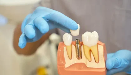 Dental Implant