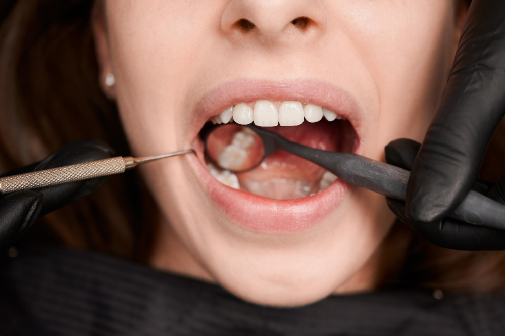 How Long Does It Take to Fill a Cavity? A Simple Dentist-Approved Guide