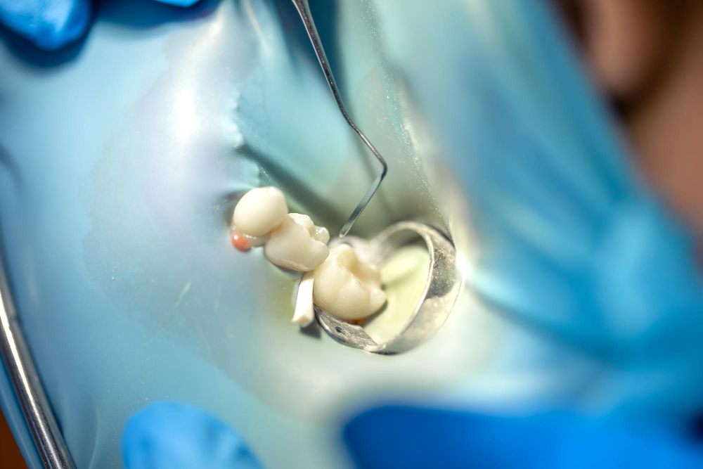 How Long Does a Cavity Filling Take on Average?